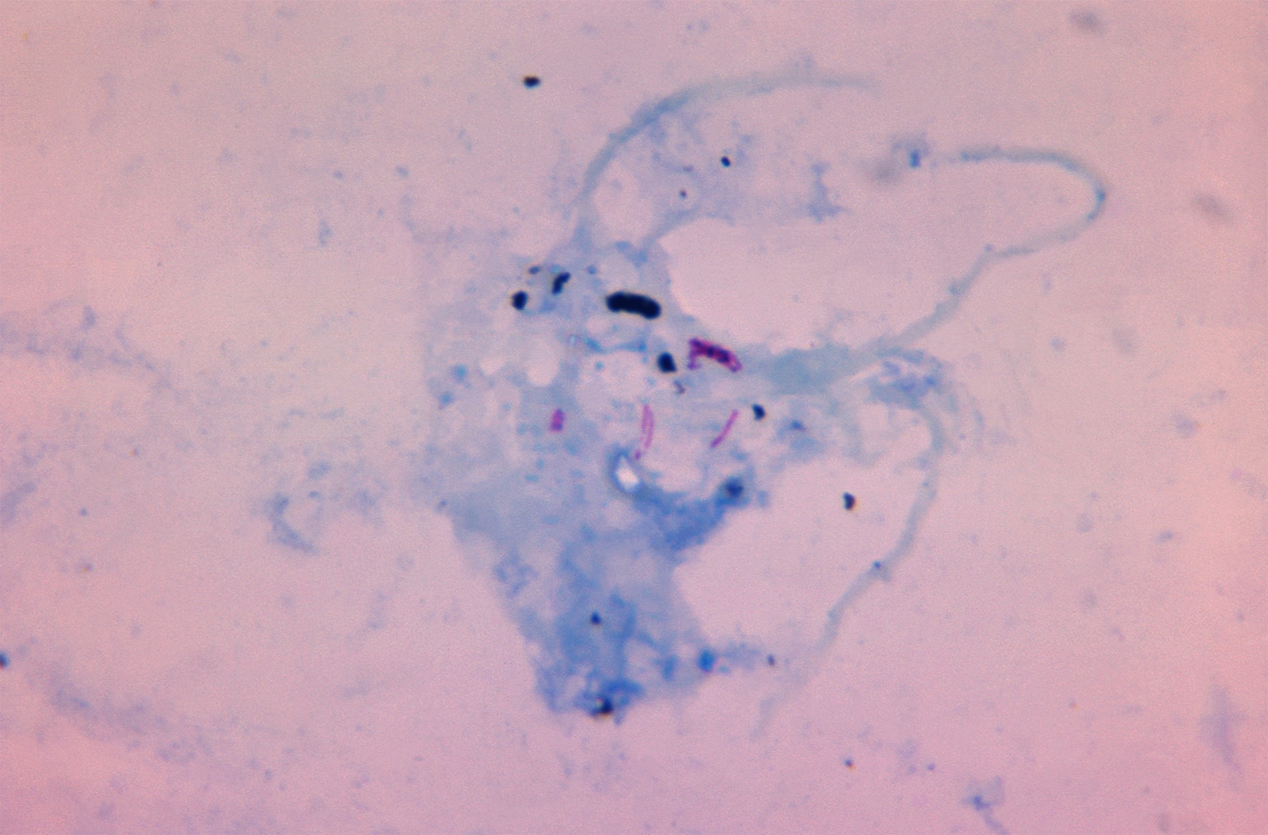 Acid-fast stain microscopy of a sputum sample showing Mycobacterium tuberculosis bacilli as pink rod-shaped organisms against blue-stained cellular material.